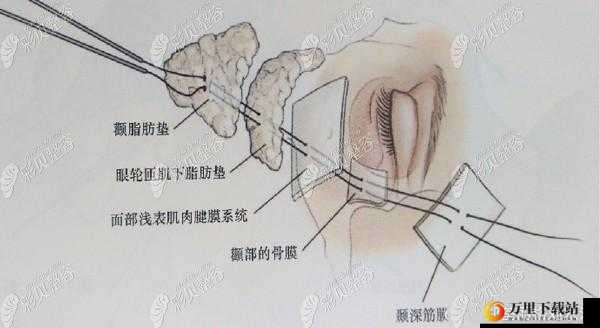 八爪鱼紧缩术：一种神奇的术式